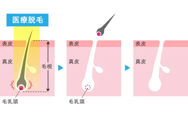 医療脱毛